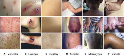 A study on the recognition of <mark class="highlighted">monkeypox</mark> infection based on deep convolutional neural networks